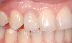 Implanty - najskuteczniejsza metoda uzupełniania braków w uzębieniu