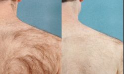 Wszystko co powinieneś wiedzieć o depilacji laserowej