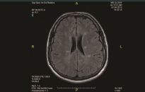 Stwardnienie rozsiane nie musi być wyrokiem