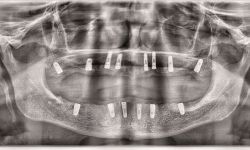 Implanty - piękny uśmiech, lepsze życie