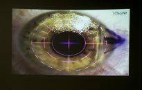 Widzieć lepiej. Co warto wiedzieć o laserowej korekcji wzroku