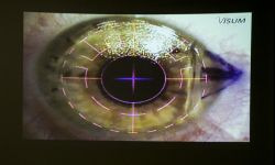 Widzieć lepiej. Co warto wiedzieć o laserowej korekcji wzroku